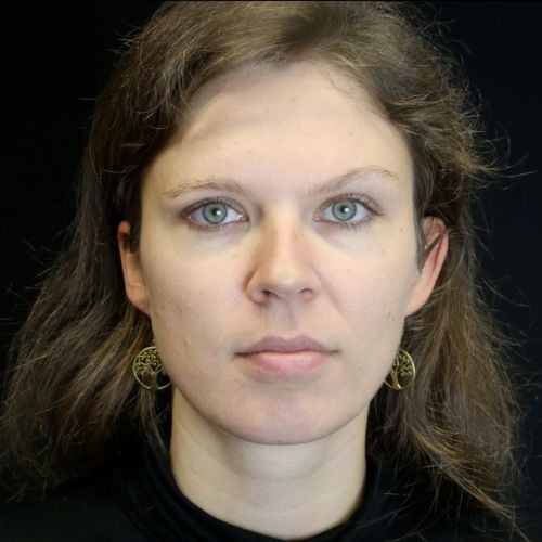 Temple Filler Brow Drop: Cannula Complications