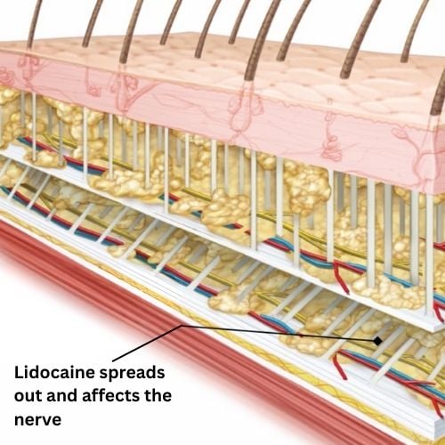 Cross-sectional diagram showing how lidocaine spreads through tissue layers and affects nerve function