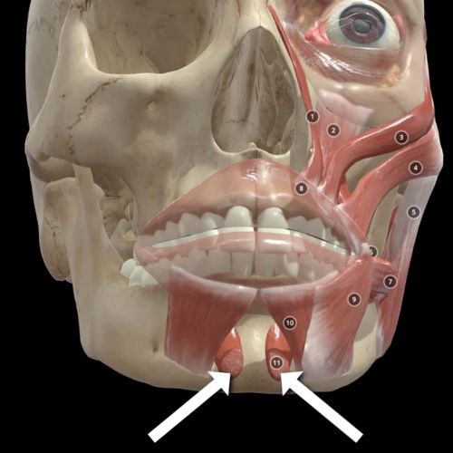 Mentalis muscle anatomy highlighted with arrows showing chin muscle position that can cause crooked smile when treated with Botox