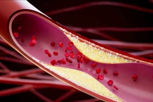 Medical illustration showing blood vessel compression by dermal filler causing external pressure and vasoconstriction