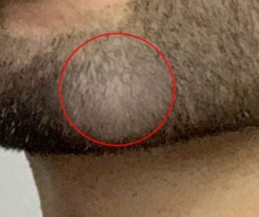 Rare Chin Filler Complication: Pressure-Induced Beard Hair Loss