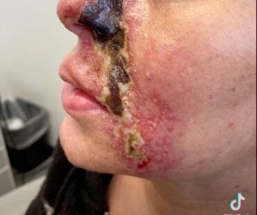 Vascular Occlusion and Necrosis Prevention: The Ultimate Safety System for Aesthetic Injectors