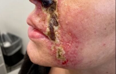 Vascular Occlusion and Necrosis Prevention: The Ultimate Safety System for Aesthetic Injectors