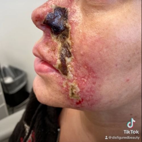 Vascular Occlusion and Necrosis Prevention: The Ultimate Safety System for Aesthetic Injectors