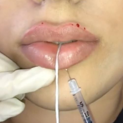 Close-up of lip filler injection technique demonstrating keyhole pout method with practitioner's gloved hand and syringe inserting into patient's lips