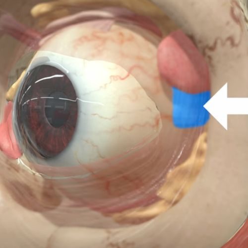 3D anatomical eye model showing lateral rectus muscle location near orbital rim with arrow indicating danger zone for Botox injections