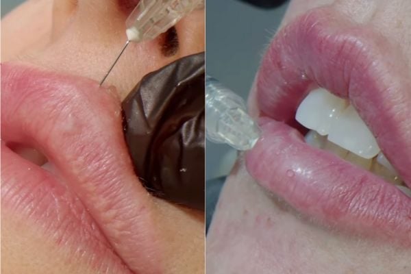 Safe Lip Filler Injection Technique and Natural Results