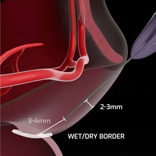 Superior Labial Artery Depth - 3D Lip Anatomy for Safe Injections