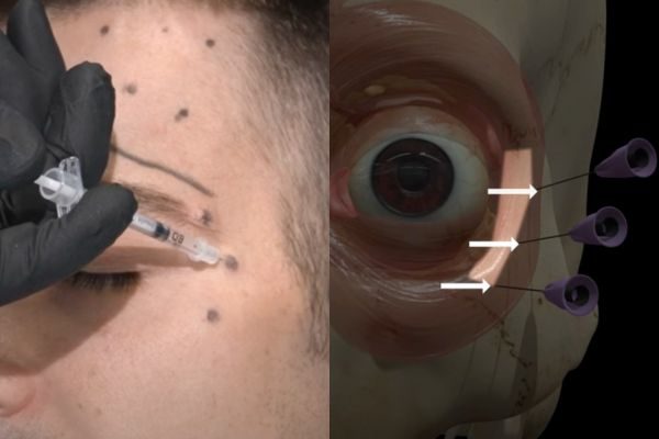 Split image showing superficial Botox injection technique for crow's feet treatment and 3D model with safe injection points marked