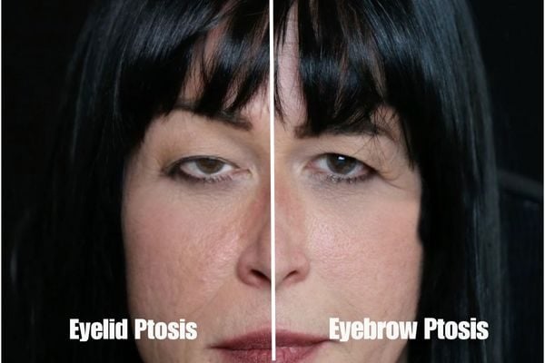 Comparison image showing eyelid ptosis versus eyebrow ptosis from botulinum toxin injection demonstrating different types of complications
