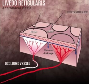 5 Early Warning Signs of Vascular Occlusion