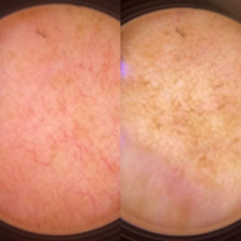 Melasma dermatoscopy