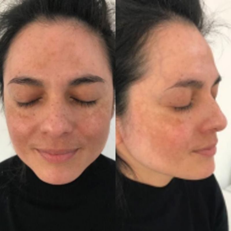 Melasma results 2 months after treatment