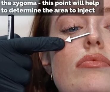 How bone surface direction determines your cheek filler results