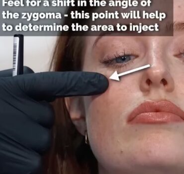 How bone surface direction determines your cheek filler results