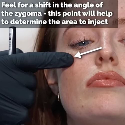 How bone surface direction determines your cheek filler results