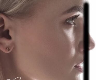 The Meeting Point Problem: Jawline Filler Techniques