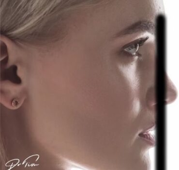 The Meeting Point Problem: Jawline Filler Techniques