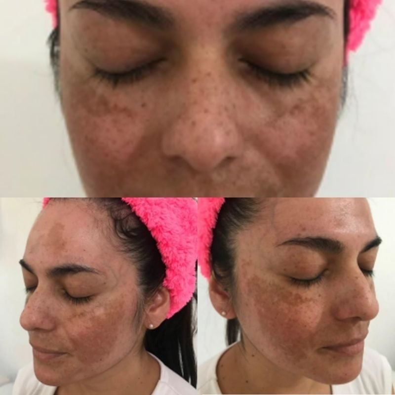 Melasma before treatment