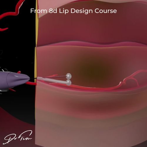 3D diagram showing filler bolus lump in lip tissue - non-inflammatory lesion from concentrated dermal filler deposit