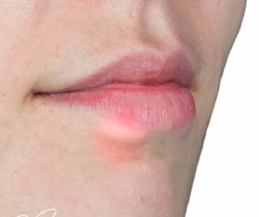 Lip Filler Lumps and Bumps: What Injectors Need to Know
