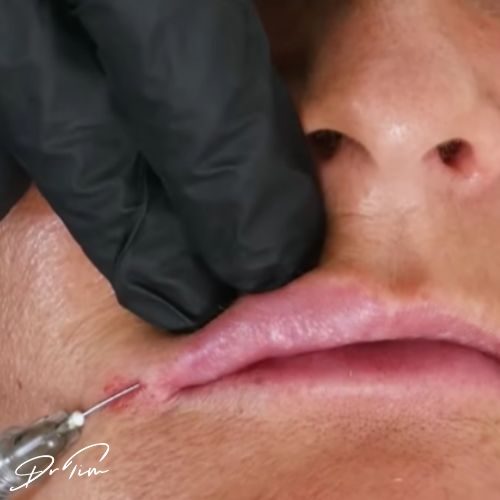 Lip filler procedural lump caused by needle trauma showing small hematoma and bruising after dermal filler injection