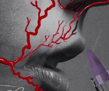 How to reduce the risk of vascular occlusion when injecting the philtrum