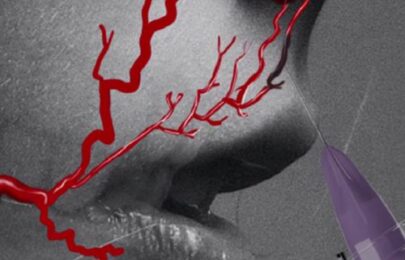 How to reduce the risk of vascular occlusion when injecting the philtrum