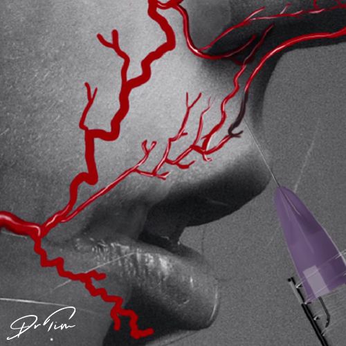 How to reduce the risk of vascular occlusion when injecting the philtrum