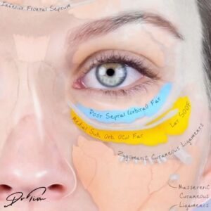 Tear troughs anatomy