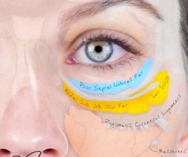 Why I Still Treat Tear Troughs: A Response to Dr. Gavin Chan’s Viral Video