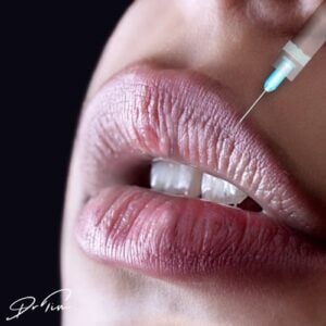 Lip Filler Volume: