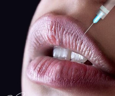 Beyond Volume: Why Expert Lip Analysis Transforms Patient Satisfaction
