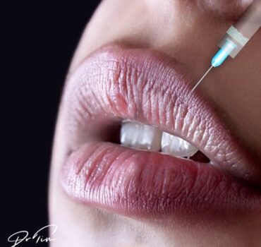 Beyond Volume: Why Expert Lip Analysis Transforms Patient Satisfaction
