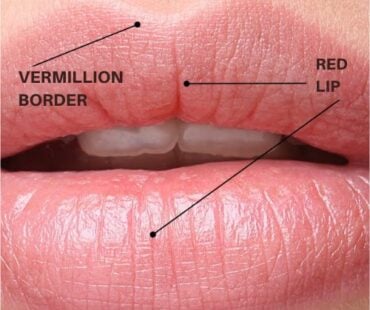 3D Lip Anatomy: Why Millimeter Precision Prevents Vascular Occlusion