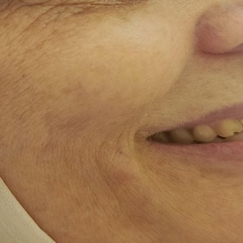 Early fine lines around the periorbital area - Dr Dima Maraqa