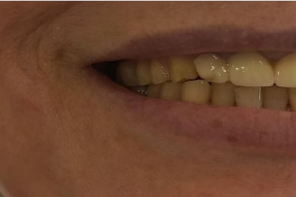 Perioral fine lines early texture change - Dr Dima Maraqa