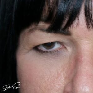 Eyelid Ptosis Example