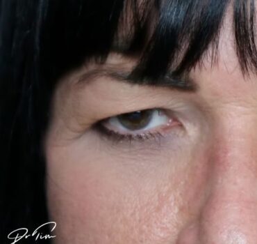 Eyelid Ptosis After Botulinum Toxin – Common Misdiagnosis