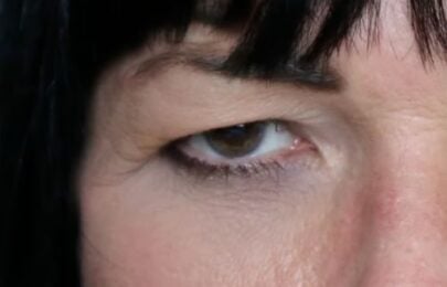 Eyelid Ptosis After Botulinum Toxin – Common Misdiagnosis