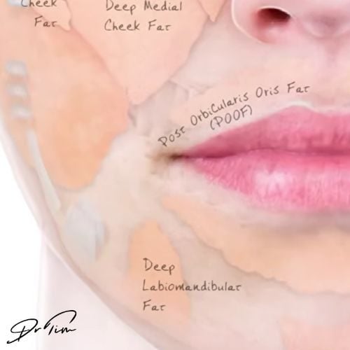 Anatomical diagram of lower face deep fat pads including post orbicularis oris fat (POOF), deep labiomandibular fat, deep chin fat, and buccal fat pad with mandibular and platysma ligaments for lower face dermal filler volume restoration