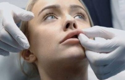 Understanding Lumps in Lips After Filler Treatment