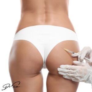 gluteal dermal filler treatment
